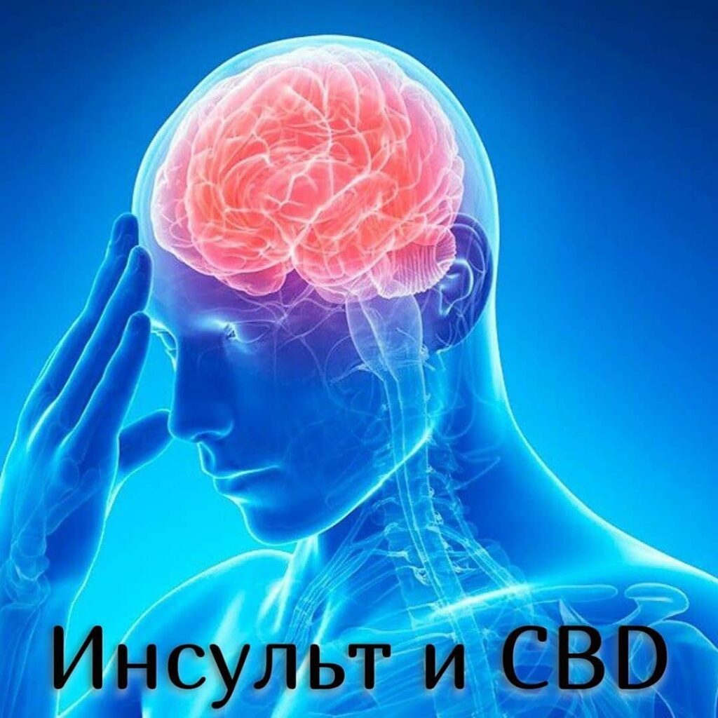 ИНСУЛЬТ И CBD купить cbd масло в России в Москве, Ишемический инсульт, CBD и болезнь сердца, Геморрагический инсульт, что такое инсульт, время инсульта, антиоксидантное действие, CBD увеличивает, CBD для восстановления